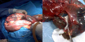 Características macroscópicas de vólvulo del sigmoides en el puerperio durante la cirugía.