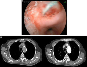 (A) Esophagus pseudodiverticula with a silver, wire shaped foreign body emerging from inside. (B) CT demonstrates an aortic stent penetrating into the esophagus.