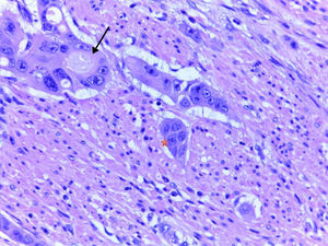 Corte histológico teñido con hematoxilina-eosina (×40) donde se observan glándulas neoplásicas de un adenocarcinoma de recto (flecha) y grupos de tumor pobremente diferenciados (estrella).
