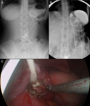 (A) Abdominal radiograph showing an enlarged gastric pouch with an air-fluid level and a dislodged gastric band with an abnormal angulation and annular appearance; (B) barium swallow depicting gastric band slippage with gastric pouch enlargement with retention of oral contrast; (C) laparoscopic image showing removal of the gastric band.