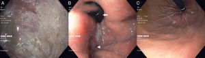 (A) Endoscopic image revealing an enlarged gastric pouch with mucosal erosions; (B) endoscopic image revealing herniation of the distal stomach (arrow) proximal to a narrowed impression (arrowhead) in the distal gastric body secondary to band displacement; (C) endoscopic image after retroflexion of the scope in the antrum, showing an easily traversed angulated constriction in the distal gastric body.