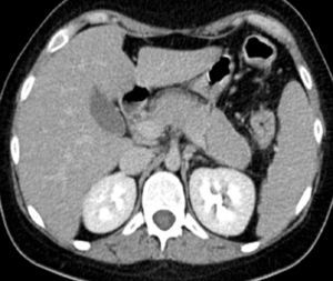 Imagen tomográfica donde se aprecia el aumento difuso del tamaño del páncreas, con captación homogénea y halo hipocaptante periférico en fase arterial.