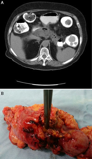 A) Fístula pancreático-colónica hacia colon descendente proximal (confirmación). B) Pieza quirúrgica.