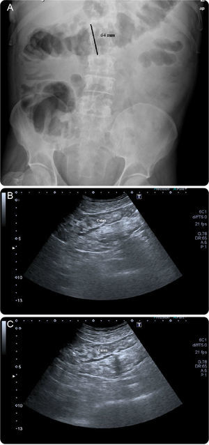 Plain abdominal radiographs (A) and abdominal US (B and C): Gross dilation of the transverse colon (diameter of 6.4cm). Abdominal US showed no intra-abdominal complications, revealing only a slight thickening of the sigmoid wall (5–6mm).