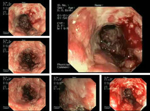Endoscopic findings (left colonoscopy) showed a severe ulcerated, patchy and hemorrhagic colitis, involving the splenic flexure until the sigmoid colon.