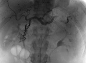Arteriografía selectiva de tronco celíaco tras embolización con coils y Gelfoam® de arteria pancreatoduodenal y esplénica.