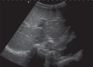 Imagen en doble carril, característica de dilatación biliar intrahepática.