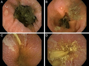 Capsule endoscopy findings. (A and B) Distal part of the jejunum, multiple small and rounded ulcers were observed. (C and D) In the ileum, linear and serpiginous ulcers were also observed.