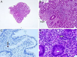 Histologic findings (right colon). Hematoxylin and eosin staining 4× and 10× magnification (A and B): marked inflammatory changes and an area of superficial ulceration (arrow). CMV immunostaining (C): immunohistochemically stained biopsy specimen showing a cytomegalovirus-positive cell (arrow); hematoxylin and eosin staining 40× magnification (D): small vessel vasculitis by a giant cell with inclusion body characteristic of CMV (arrow).