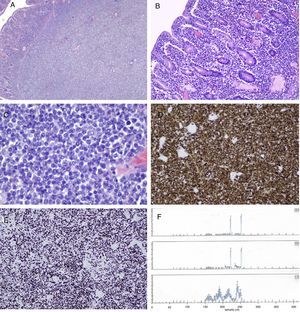 Histopatología en enteropatía asociada a linfoma T tipo II de la OMS. A) Infiltración transmural de la pared ileal por denso infiltrado linfocitario (H&E, ×40). B) Invasión de lámina propia de la mucosa y epitelio de las criptas por el infiltrado linfoide (H&E, ×200). C) Población linfoide monomorfa de linfocitos atípicos de pequeño tamaño con escaso citoplasma (H&E, ×400). D) Inmunoexpresión de CD3 (×200). E) Inmunoexpresión de Ki-67 (80%) (×200). F) Reordenamiento monoclonal para TCR gamma.