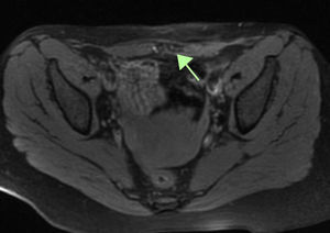 Corte axial de RMN en secuencia T1 con saturación grasa, en el que se observa lesión hipoecoica, con imágenes hiperintensas en el interior compatibles con focos hemorrágicos.