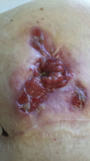 Pioderma gangrenoso periestomal antes de iniciar el tratamiento con infliximab.