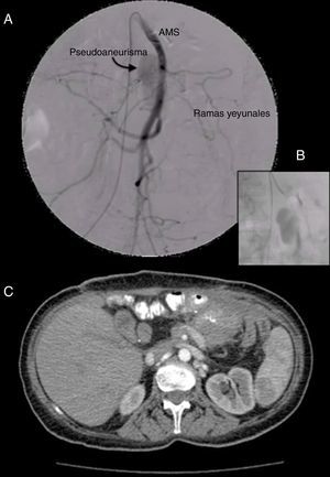 Arteriografía y embolización del seudoaneurisma: A) Arteriografía de la arteria mesentérica superior (AMS) identificando el seudoaneurisma (flecha). B) Detalle de la cateterización y embolización selectiva. C) TAC de control en la que ya no se observa la presencia del seudoaneurisma.