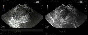 Imagen ultrasonográfica en la que se aprecia la masa hipoecogénica pancreática. En la figura de la derecha se muestra el pase efectuado con aguja de histología de 22G ProCore®.