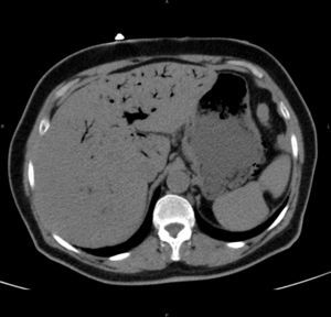 TAC abdominal sin contraste. Corte axial: burbujas aéreas en pared gástrica y engrosamiento difuso de la pared. Abundante gas en parénquima hepático y en sistema portal.