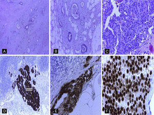 A) Adenocarcinoma ductal bien diferenciado infiltrante de páncreas, (hematoxilina y eosina [H&E], ×20). B) Infiltración de la grasa peripancreática e infiltración perineural por adenocarcinoma ductal pancreático, (H&E, ×40). C) Metástasis en ganglios peripancreáticos por un carcinoma con morfología diferente a la del adenocarcinoma pancreático, (H&E, ×40). D) Tinción intensamente positiva para CK19 en la micrometástasis ganglionar, (H&E, ×20). E) Mamaglobina intensamente positiva (tinción citoplasmática) en micrometástasis ganglionar por carcinoma mamario, (H&E, ×40). F) Receptores de estrógenos intensamente positivos (tinción nuclear) en micrometástasis ganglionar por carcinoma mamario.