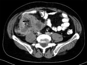 Tomografía axial computarizada de abdomen, con contraste oral e intravenoso. Se aprecia una gran masa en fosa ilíaca derecha, de 10,2×8,8cm, que afecta a íleon terminal y asas de íleon distal adyacentes y, también parece englobar el apéndice, con desplazamiento lateral del ciego. El interior de la masa muestra contenido líquido y de contraste oral, con burbujas de gas, probablemente por necrosis y ulceración.