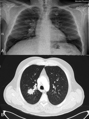 A) Radiografía de tórax: masa en lóbulo superior derecho. B) Tomografía axial computarizada, con contraste oral e intravenoso, donde se observa una masa mal definida de contornos espiculados, que se extiende desde la región hiliar derecha con obstrucción del bronquio del LSD y del bronquio para el segmento posterior, de 50×27mm en plano axial, asociado a adenopatías hiliares derechas.