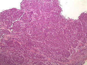 Cáncer gástrico difuso. Focos tumorales múltiples, con células en anillo de sello, propagados a través de toda la mucosa gástrica. (Foto cedida por Miriam Cuatrecasas).