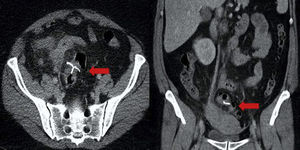 Imágenes de la tomografía computarizada, en la cual, las flechas señalan la ubicación del dispositivo intrauterino en la cavidad abdominal.