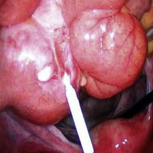 Dispositivo intrauterino incluido en el intestino delgado, observado durante la laparoscopia.