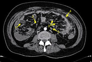 CT showing (1) blood content in jejunum, (2) multiple peritoneal implants, (3) omental cake, (4) thickening of the omentum, (5) lymphadenopathy.
