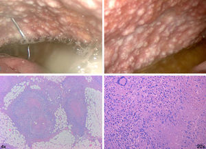 On the top, two captures showing laparoscopy with multiple nodules both parietal and visceral peritoneum. On the bottom, pathology sample of the omentum showing abundant epithelioid granulomas with caseous necrosis (1) and giant cells on the periphery (2).