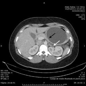 Imagen de TC abdominopélvica con área hipocaptante en cola de páncreas (flecha blanca) adyacente a balón intragástrico (flecha negra).