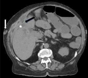TAC. Flecha blanca: trayecto fistuloso. Flecha negra: vesícula adherida a peritoneo parietal.