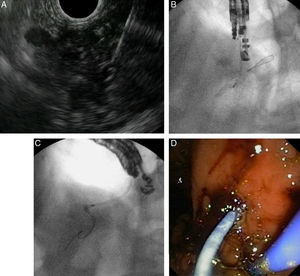 EUS-guided pancreatic duct drainage after failed ERCP. (A) Pancreatic duct (PD) access by EUS-guided puncture using a 19G needle; (B) pancreatography and creation of a pancreaticogastrostomy using a cystotome over a guidewire; (C) plastic stent delivered inside the PD. (D) A 7Fr transgastric plastic stent, well positioned in the gastric cavity.