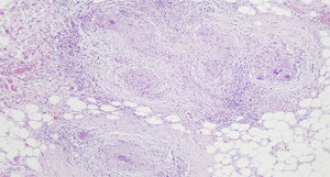 Granulomas necrosantes, con necrosis caseosa central rodeada de células gigantes multinucleadas.