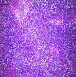 Neoplasia difusa y nodular de linfocitos (tinción hematoxilina-eosina ×40).
