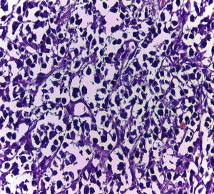 Células linfoides patrón difuso, núcleos hipercromáticos, escaso citoplasma (tinción hematoxilina-eosina ×400).