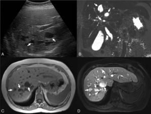Ultrasound image (A) demonstrates multiple intrahepatic cysts (arrows). Coronal conventional T2-weighted MR cholangiography (B) and axial pre-contrast T1-weighted MR image (C) confirm the finding of multiple liver cysts in close relation to the biliary tree (arrows), some of them with the central dot sign (B). Late hepatobiliary phase of contrast-enhanced MR cholangiography using gadoxetic acid (D) demonstrates filling of cysts by contrast agent (arrows), proving their communication with the biliary tree and adding complementary information supportive of a diagnosis of Caroli disease.