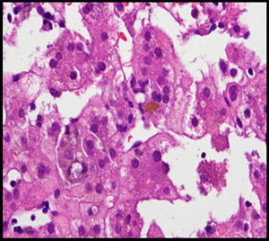 Hepatocitos con presencia de pigmento biliar intracitoplasmático (hematoxilina-eosina).