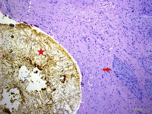 Imagen histológica del conducto cístico con litiasis (asterisco) fibrosis, e hiperplasia de plexos nerviosos (flecha).