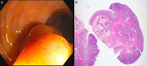 (A) Endoscopic image showing a 20mm pedunculated polyp with thick stalk; (B) histological image showing a pedunculated polyp with thick stalk having numerous glands in the muscularis mucosae and submucosae, some with mucus dilatation, surrounded by an haphazard and fibrotic muscularis mucosae with congestive ectatic vessels, showing continuity with the overlying mucosae (HE, 1.5×).
