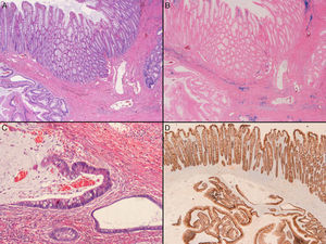 The crypts within muscularis mucosae are lobular and well demarcated (left side) or more irregular (right side) [A – HE, 20×] and multiple foci of hemosiderin are seen throughout the muscularis mucosae [B – Perls, 20×]. Some glands are irregular and dilated by extracelullar mucus [C – HE, 100×]. There is no decreased intensity of E-Cadherin in the misplaced epithelium [D – 20×].