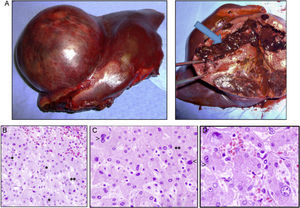 A) Imagen macroscópica del tumor que aparece bien delimitado del hígado normal y con abundante hemorragia (flecha). B) La histología muestra la congestión sinusoidal (arriba a la derecha) y la formación de estructuras seudoacinares en las zonas displásicas (*), a veces con bilis (**). C y D) Detalle del pleomorfismo nuclear de los hepatocitos con núcleos grandes (<) y con desproporción núcleo citoplasma, binucleaciones (>) y formación de seudoacinos (*). (B a D: hematoxilina-eosina).