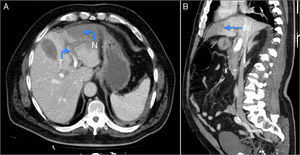 TAC abdominal: A) Corte axial. N: necrosis hepática; T: trombo en vena porta izquierda. B) Corte coronal: N: necrosis hepática.