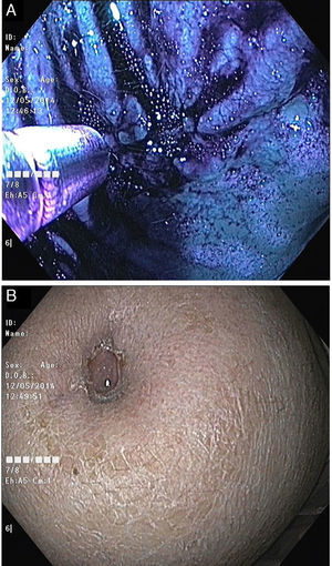 (A) Endoscopic image showing methylene blue instillation over the previous gastric defect. (B) No extravasion of methylene blue through the cutaneous orifice occurred.