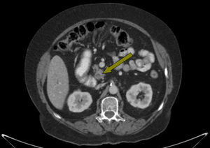 Coledocolitiasis distal. Corte de la TC abdominal, donde se observa contenido litiásico en el extremo distal del colédoco, que condiciona la dilatación retrógrada de la vía extrahepática, sin identificar anormalidades en la porción cefálica pancreática.