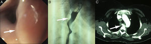 A) Endoscopia digestiva alta. La flecha señala un área pulsátil sugestiva de un vaso anómalo. B) Tránsito baritado. La flecha señala la impronta en el esófago, secundaria a una arteria subclavia derecha aberrante (ASDA). C) Tomografía computarizada. La flecha señala la ASDA, y cómo esta desplaza al esófago hacia la izquierda.