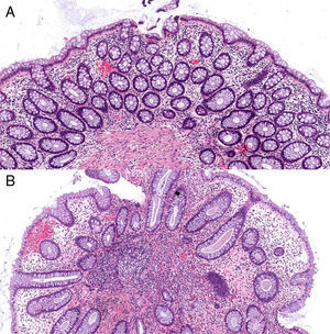 Tinción hematoxilina-eosina x 100 aumentos. 2.A: mucosa de intestino grueso con la arquitectura conservada, criptas revestidas por células caliciformes y escaso infiltrado inflamatorio linfocitario de carácter inespecífico en la lámina propia. 2.B: formación polipoide con epitelio colónico distorsionado mostrando algunas criptas levemente dilatadas y otras ramificadas, rodeadas por lámina propia inflamatoria.