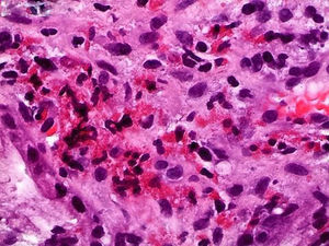 Imagen AP de la mucosa de bulbo duodenal con la presencia de más de 100 eosinófilos en campo de gran aumento (CGA).