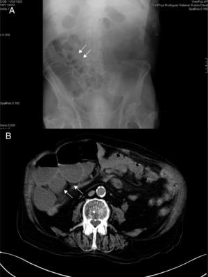A) Radiografía de abdomen con asas de intestino delgado dilatadas y niveles hidroaéreos. B) Tomografía axial computarizada de abdomen, sin contraste. Distensión de asas de intestino delgado. En ambas imágenes, una vez conocido el diagnóstico, pueden intuirse los divertículos (flechas).
