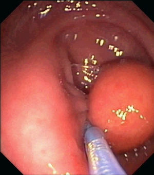 Endoscopic image showing the placement of the first endoloop at the pseudopedunculated base of the lipoma.