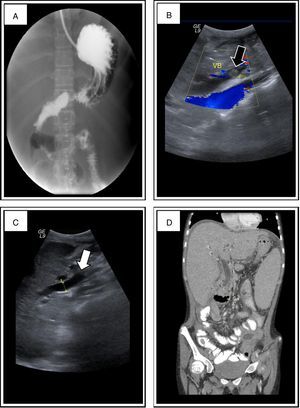 A) Serie esofagogastroduodenal y tránsito intestinal en el que se encuentran defectos de llenado en estómago, duodeno y yeyuno compatibles con pólipos. B y C) Estudio ultrasonográfico en el que se documenta aumento de la ecogenicidad en el interior de la vesícula biliar, que no moviliza con maniobras de gravitación, sin sombra acústica posterior, compatible con pólipo (flecha negra), y dilatación del conducto colédoco (flecha blanca). D) Tomografía axial computarizada (TAC) en la que se encuentra dilatación del conducto colédoco, hepatomegalia y esplenomegalia.