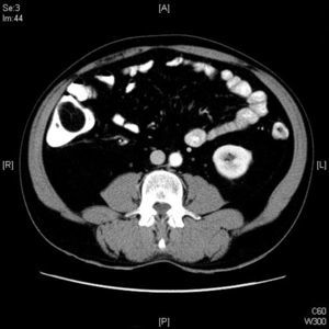 Intususcepción ileocólica de lipoma ileal: imagen tomográfica.