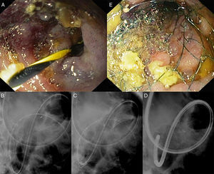 (A) Endoscopic image showing the guide-wire passing through the jejunal stenosis. (B) Fluoroscopic image showing the advancement of the SEMS over the wire and through the overtube. (C) Fluoroscopic image revealing the release of the SEMS while the overtube was slightly pulled back. (D) Fluoroscopic image depicting proper placement of the SEMS in the stenosis. (E) Endoscopic image, after releasing the stent and reintroducing the enteroscope, showing the stenosis with the SEMS.